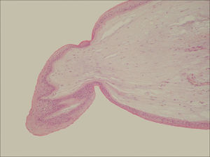 Histology of the Vocal Cord Nodule. Overview of the vocal fold nodule histology stained with hematoxylin and eosin (HE 20x). Presence of hyperplastic epithelium, basement membrane thickening and few changes in the lamina propria.