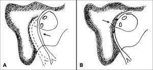 A: Facial nerve anastomosis; B: Facial nerve grafting.