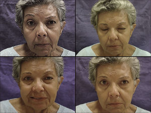 Grafting. Absent frontal muscle contraction to the left; complete closure of left eye; contraction of labial commissure; good facial symmetry at rest.