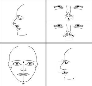 Anatomical parameters used for facial analysis. n: Nasion; prn: Pronasale; sn: Subnasale; c’: Columella apex; al: Nasal wing, most lateral point; sn’: Columella lateral border; zy: Zygion; gn: Gnation; sto: stomion7.