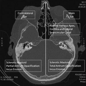Axial CT Scan. Comparison of abnormalities in the main (left) and contralateral (right) ear.