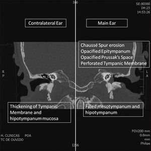 Coronal CT Scan. Comparison of abnormalities in the main (left) and contralateral (right) ear.