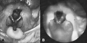 Laryngeal membrane in a child aged four months. A: Extensive laryngeal membrane producing tight evenly shaped round posterior glottic lumen; B: Endoscopic examination nine days after dilation procedure showing notable increase in glottic lumen despite remnants of congenital malformation.