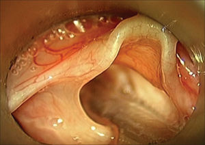 Intraoperative aspect of a 3 - month old child with laryngomalacia, detail of the aryepiglottic fold shortening.
