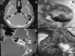A: CT scan showing the communication between the mastoid cavity and the posterior fossa; B: Intraoperative image of a mastoidectomy showing the communication between mastoid air cells and the posterior fossa (A); C: occlusion with a temporal muscle pedicled flap; D: Six months after surgery: closure of the communication, occlusion of the mastoid and middle ear (A) and absorption of the pneumocephalus (B).