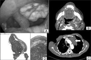 A: macroscopic view of a tumor in the left tonsillar bed; B: axial view of a neck CT scan (white arrow: tumor in the oropharynx; black arrows: lymph nodes); C: axial view of a chest CT scan (white arrow: tumor in the left upper lobe); D: squamous mucosa invaded by small-cell lung carcinoma characterized by mid-size trabecular tumor cells with round and oval nuclei and scarce cytoplasm; original magnification and 35x original magnification.
