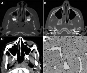 A: Preoperative axial CT scan showing the tumor inserted into the nasal septum and extending to the choanae; B: Axial CT scan showing preoperative pterygopalatine fossa without disease involvement; C: Axial CT scan postoperatively; D: HE histological section showing spindle cell proliferation with hyalinization areas intermingled with vessels - sometimes arched.