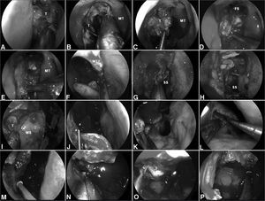 A-B: Intraoperative photographs demonstrating the resection of a right ethmoidal adenocarcinoma. Firstly, the tumor is debulked to identify it origin; C-D: Subperiosteal dissection of the tumor separates it from the medial orbital wall, nasoethmoidal complex and nasofrontal recess; E: The dissection continues along the maxillary line and posteriorly, along the lamina papyracea, to reach sphenoid sinus; F: The left middle turbinate is removed to establish an adequate margin and to expand the space for instrumentation; G-H: Wide sphenoidotomies establish the posterior margin; I: Residual tumor at the anterior aspect of the medial wall of the maxillary sinus cannot be adequately removed via a midmeatal antrostomy; J: An endoscopic medial maxillectomy is performed with the resection of the inferior turbinate; K: The resection extends from the orbit down to the floor of nose; however, its' exposure is insufficient. Therefore, an endoscopic Denker's approach is deemed necessary for a full exposure; L: The piriform aperture and ascending process of the maxilla are removed, dissecting the nasolacrimal duct and transecting it sharply. Exposure of the piriform aperture requires a vertical incision on the edge of the aperture; M-N: This edge can be palpated with a blunt dissector to optimize the placement of the incision, which is then carried through the periosteum down to bone. A subperiosteal lateral dissection exposes the anterior maxilla. The medial maxillectomy is then extended to remove the piriform aperture and sufficient anterior maxillary wall to expose the entire confines of the antrum; O-P: This corridor facilitates the adequate resection of tumor with negative margins; T: Tumor; MT: Middle turbinate; FS: Frontal sinus; SS: Sphenoid sinus; MS: Maxillary sinus; IT: Inferior turbinate.