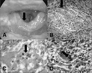 Laryngoscopy: Ulcerative-infiltrative-vegetative lesion on the anterior surface of the epiglottis (a); Histopathology: HE 200x granuloma (b); fungus Paracoccidioides PAS 100x (c); Grocott 400x Mickey-Mouse-type budding (d).