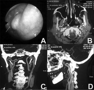 A: Nasal endoscopy image showing a pulsating mass in the lateral recess of the nasopharynx. B, C, D: Contrast-enhanced CT scan of the neck; axial, coronal, and sagittal views, respectively, showing a kinked right internal carotid artery.