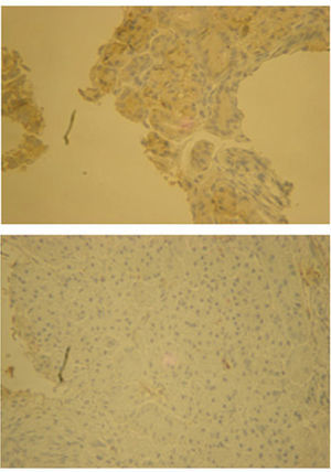 Immunohistochemical study for estrogen receptors before (A) and after (B) hormone therapy (40×).