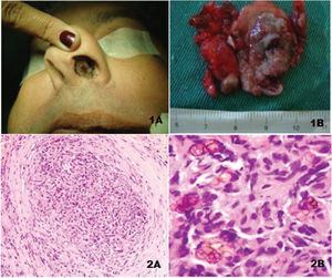 Clinical image of the septal lesion (1A). Lesion removed with mucosal segment (1B). HE, small increase (2A). Chronic granulomatous inflammatory process with rounded and brownish fungi, some with septa. HE, large increase (2B).