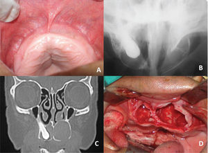A, Palatal bilateral swelling. B, Radiolucent area with expansion of the buccal cortical on the left side, and a canine tooth associated with a radiolucent area on the right side. C, Hypodense areas in the coronal view of computed tomography. An elevation in the left nasal fossa floor is visible. D, Surgical cavities.