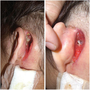 Dehiscent retroauricular incision. Left image: aspect 80 days after surgery; and on the right: 30 days after start of treatment for tuberculosis, showing improved healing.