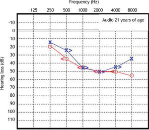 Audiometry in patient 1, performed at 21 years of age.