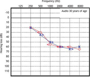 Audiometry in patient 1, performed at 30 years of age.