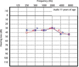 Audiometry in patient 2, performed at 11 years of age.