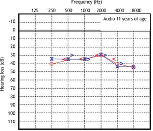 Audiometry in patient 2, performed at 26 years of age.