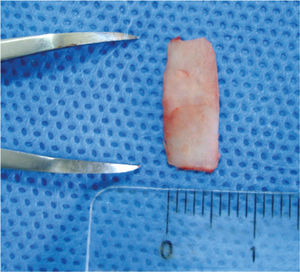 Preparing a 0.5-cm wide strip of cartilage, measured with a surgical compass without Gelfoam®.