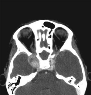 Computed tomography scan (axial view) of a juvenile angiofibroma extending into the right cavernous sinus.