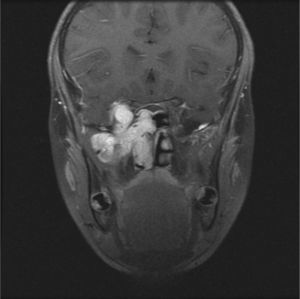Magnetic resonance imaging (coronal view) of the same patient as Figures 1 and 2.