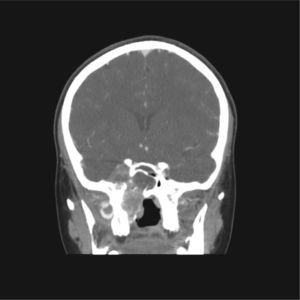 Postoperative computed tomography scan showing the extent of resection and a tumor recurrence.