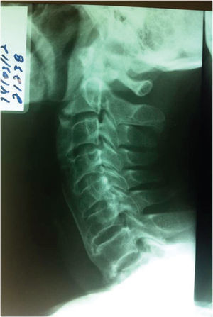 Plain profile X-ray of the cervical spine showing diffuse calcification in the anterior longitudinal ligament and calcification areas in the posterior longitudinal ligament.