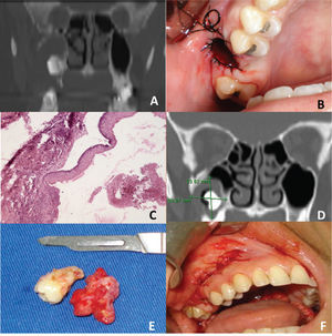 A, Coronal view of computed tomography showing the obstruction of the right maxillary sinus by a lesion of cystic aspect associated with a molar tooth. B, Decompression of the lesion under local anesthesia. C, Coating epithelium parakeratinized H&E with 100×magnification. D, Coronal view at 18 months postoperative. E, Removal of cyst and the associated tooth. F, Primary closure of wound