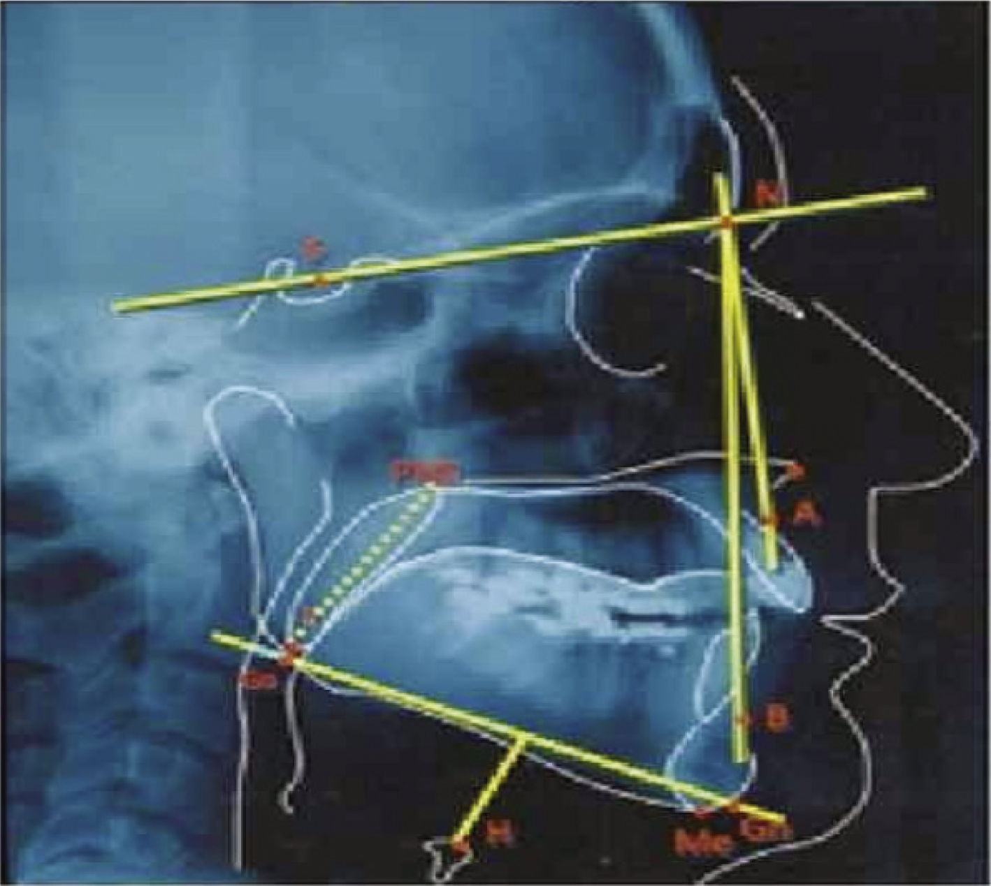Correlation between cephalometric data and severity of sleep apnea ...