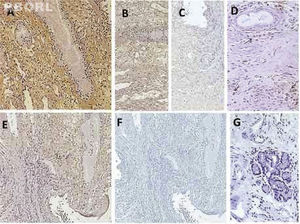 HLA-G protein detection SNP biopsies. Photomicrograph showing different categories of immunolabeling intensity. A, Strong staining by epithelial cells; B, Moderately and C, weak staining; D, Expression of HLA-G by immune-inflammatory cells; E, Positive SNP patient sample to HLA-G expression and F, the isotype control (irrelevant antibody); G, Negative sample to HLA-G expression. Original magnification 10× (B,C and F), 20× (A) and 40× (D and G).