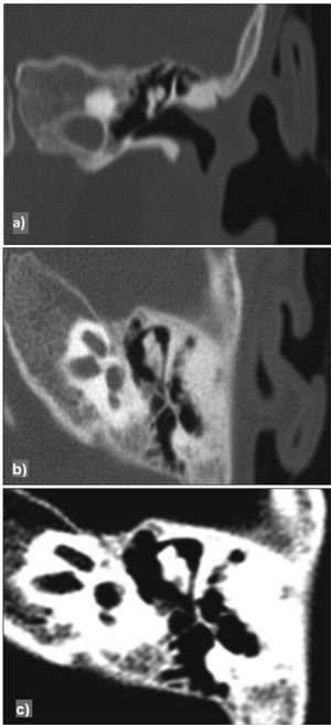 High-resolution computed tomography of the left ear (case 1), coronal (a), sagittal (b), bone window (c).