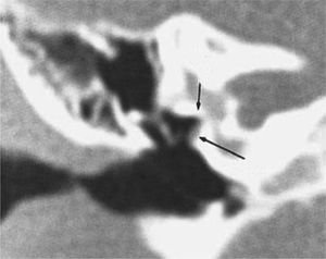 High-resolution computed tomography of the left ear (case 2), demonstrating absence of the oval window and change in the course of facial nerve.