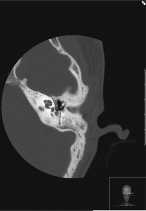High-resolution computed tomography of the left ear (case 3), demonstrating absence of stapes and of incus lenticular apophysis.