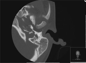 High-resolution CT scan of left ear (case 3) showing a persistent stapedial artery.