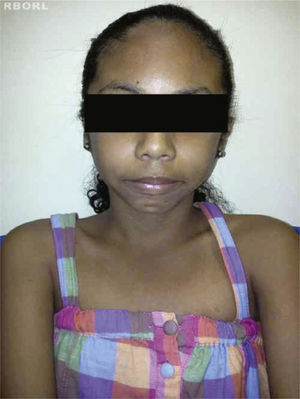 Frontal view of a patient with Turner's syndrome.
