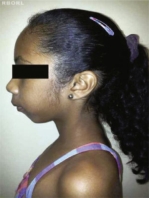 Lateral view of a patient with Turner's syndrome.