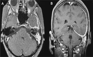 A, Axial view of head magnetic resonance imaging shows the high T2 signal in left mastoid cells. B, Coronal view of head magnetic resonance imaging exhibits ipsilateral cerebellar tentorium and middle fossa leptomeningeal plan enhancement after gadolinium is injected.