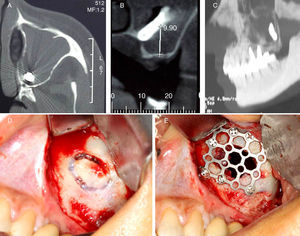 (A) TC axial, (B) TC coronal, (C) TC sagittal, (D) Calwell-Luc approach and (E) reconstruction of the sinus anterior wall with a titanium mesh.