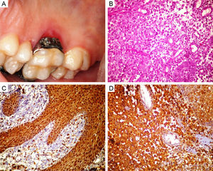 (A) Intraoral clinical imaging showing red ulcerated lesion in the palatal gingiva, adjacent to the first upper molar. (B) Microphotograph showing neoplastic lesion characterized by polygonal cells, at times exhibiting granular cytoplasm among numerous blood vessels, and inflammatory infiltrate consisting of lymphocytes, neutrophils, and eosinophils (HE ×400). (C) Immunohistochemical findings positive for S100 (×200). (D) Immunohistochemical findings positive for CD1A (×400).