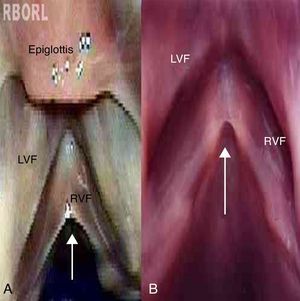 Laryngeal micro-diaphragm (arrow). (A) Shows larynx 52, and (B) shows larynx 54. (LVF, left vestibular fold; RVF, right vocal fold).
