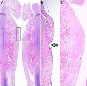 (A) Frontal histological section of larynx 9, HE staining. In the detail, (B) left sulcus vocalis, indicated by the arrow (up to 20×). (C) Frontal histological section of left vocal fold without alterations, in larynx 2, which showed no alteration at the inspection and instrumental palpation examination, HE staining, 12× magnification.