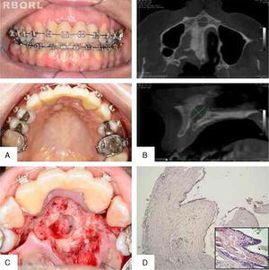 (A) Intraoral clinical appearance, with no abnormalities on physical examination. (B) Axial maxillary CT shows the mediolateral view of the lesion. Maxillary sagittal acquisition shows anteroposterior and superoinferior views. (C) Surgical cavity after total enucleation of the lesion. (D) Photomicrograph shows the presence of cystic lesion lined by thin pseudostratified epithelium, and dense fibrous capsule with a chronic inflammatory infiltrate (HE, 40×). With higher magnification, the lower corner on the right shows the presence of round and flat cells in the epithelial lining (HE, 400×).