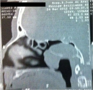 Paranasal sinus tomography showing a sphenoid sinus tumor extending into the cavum.