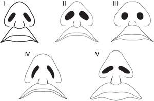 Nostril models in young Turkish females.