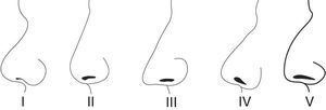 Nasal profiles in young Turkish males.