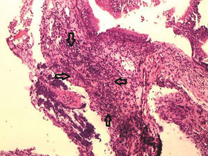 Sinus mucosa on the right side of the study group euthanized after 10 days, with moderate inflammation characterized by diffuse inflammatory infiltrate in the lamina propria, without formation of inflammatory aggregates (grade 2), delimited by arrows – optical microscope, HE staining, 100× magnification.
