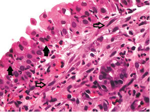 Sinus mucosa on the right side of the study group euthanized after 17 days, with severe inflammation (grade 3), demonstrating the epithelium permeated by neutrophils (filled arrows) and fibroblasts (hollow arrows) in the superficial corium. Optical microscope, HE staining, 200× magnification.