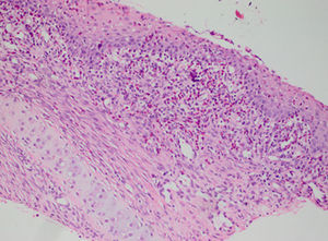 Severe acute inflammation of the submucosa (H–E 200×).