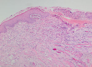Ulceration of the mucosa (H–E 100×).