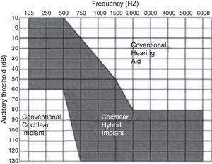 Illustrative graphic of the audiometric pattern expected in hybrid-implant candidates.